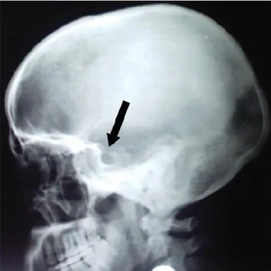 X-ray Skull LAT Coned View for Sella